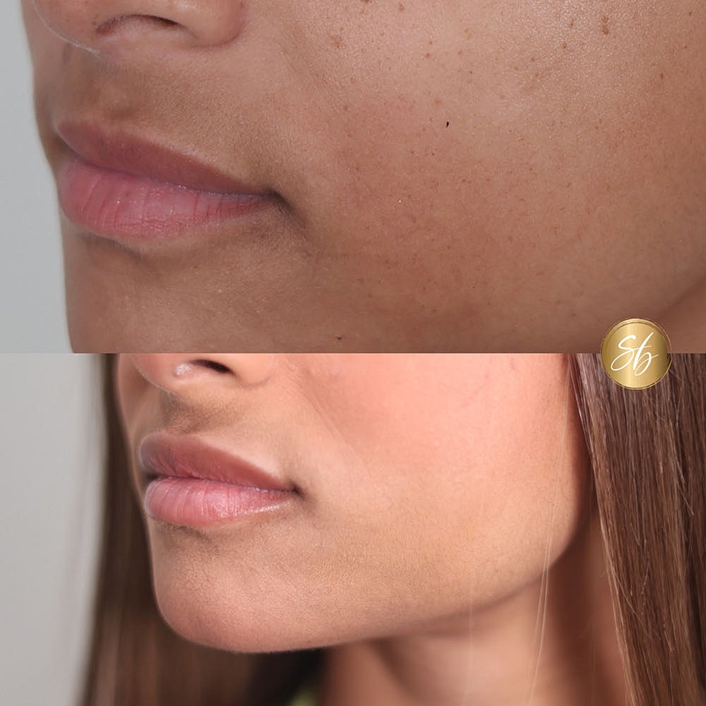 Skin texture comparison before and after treatment.