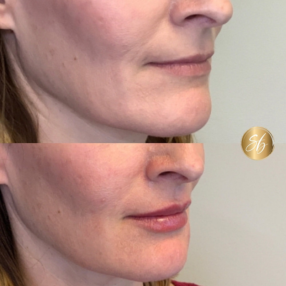 Before and after skin treatment side view.