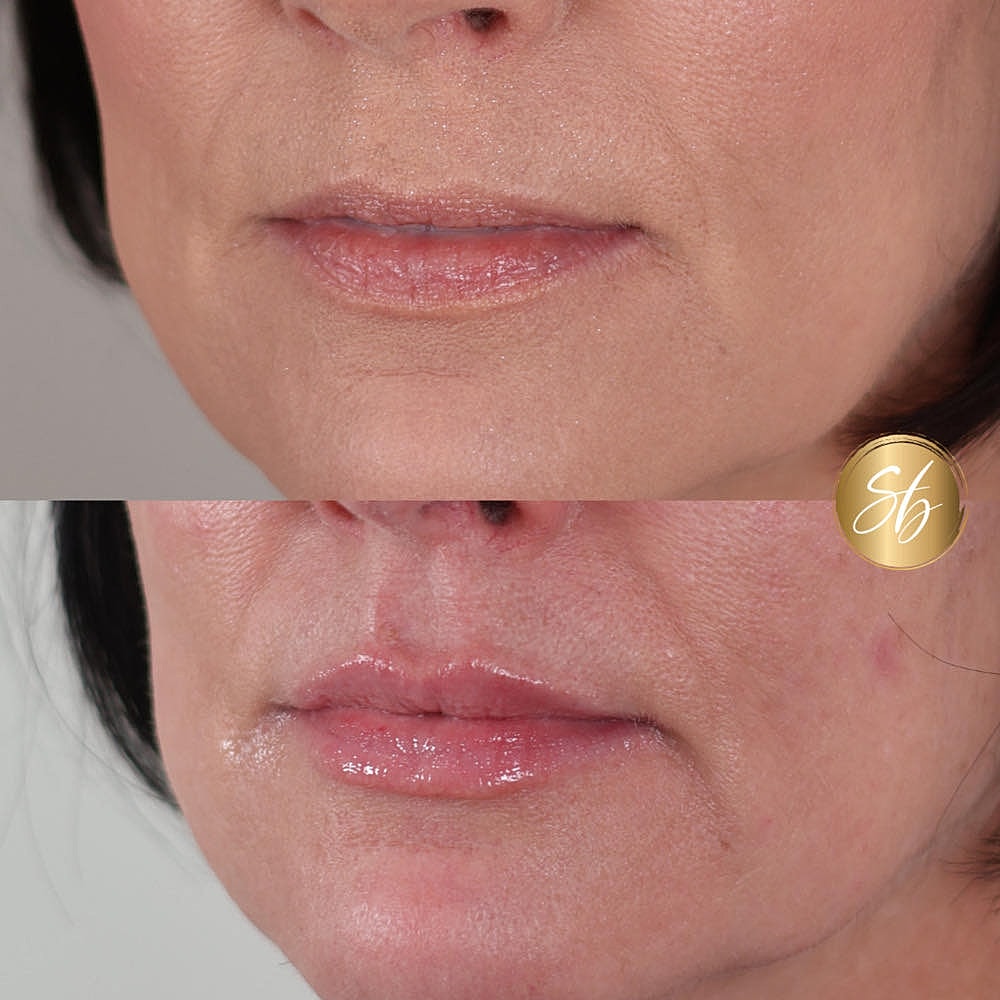 Before and after lip treatment comparison