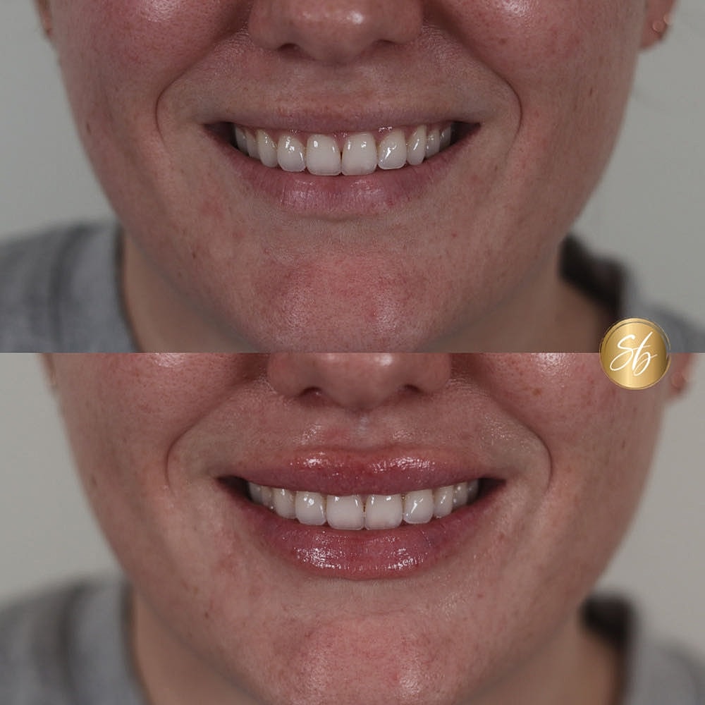 Before and after smile transformation comparison.