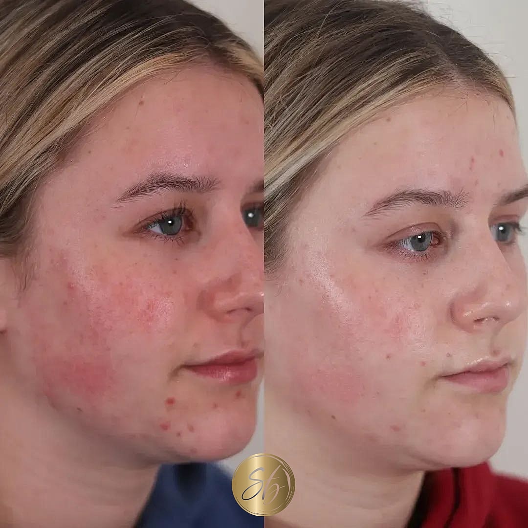 Bbl Forever Clear Before & After