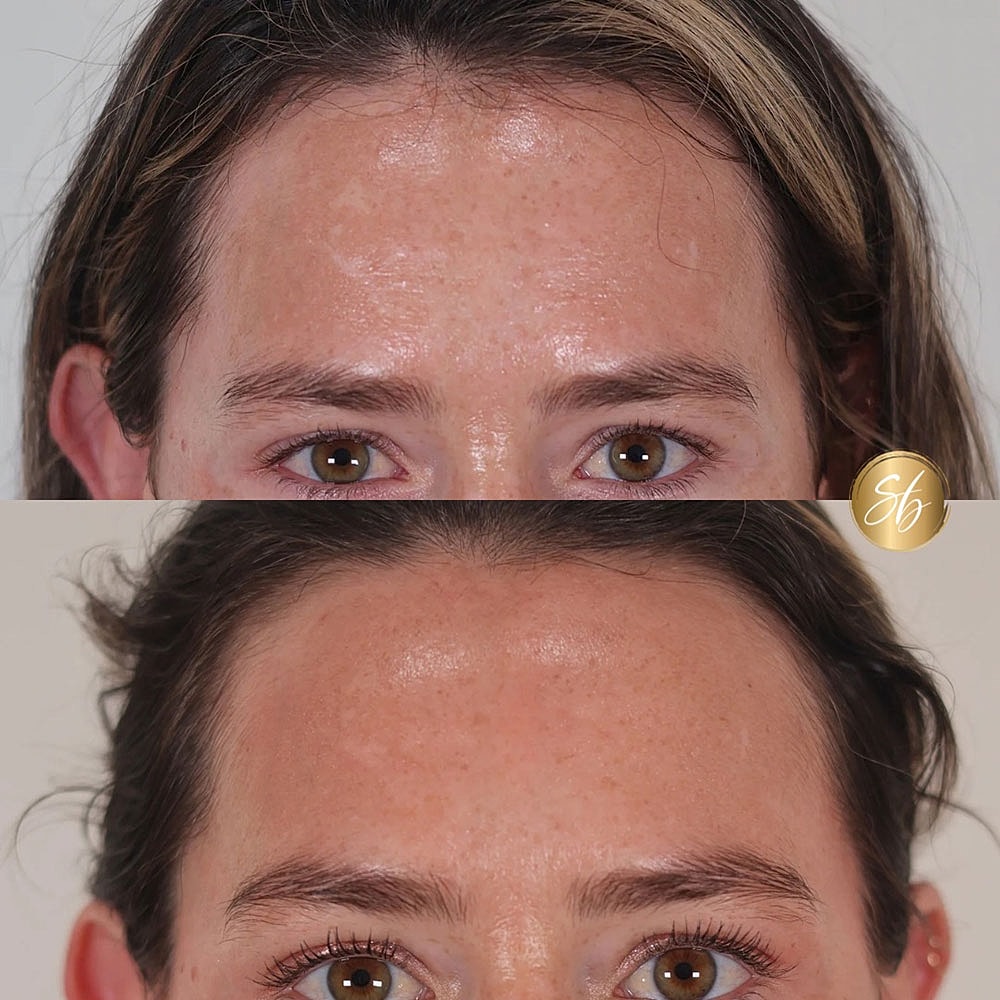 Before and after skincare treatment comparison.