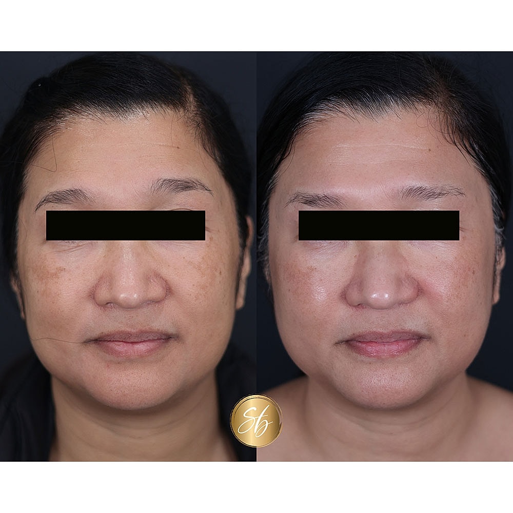 Before and after facial rejuvenation comparison.