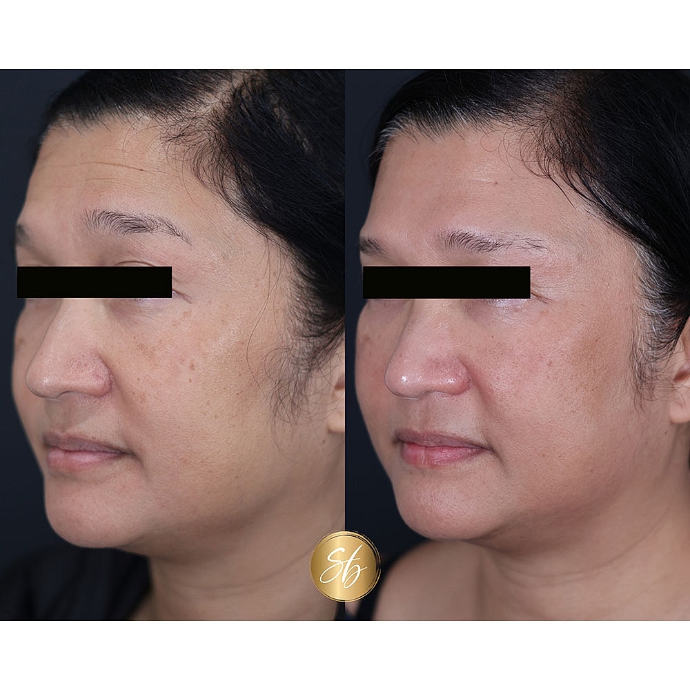 Before and after cosmetic treatment showing facial improvement.