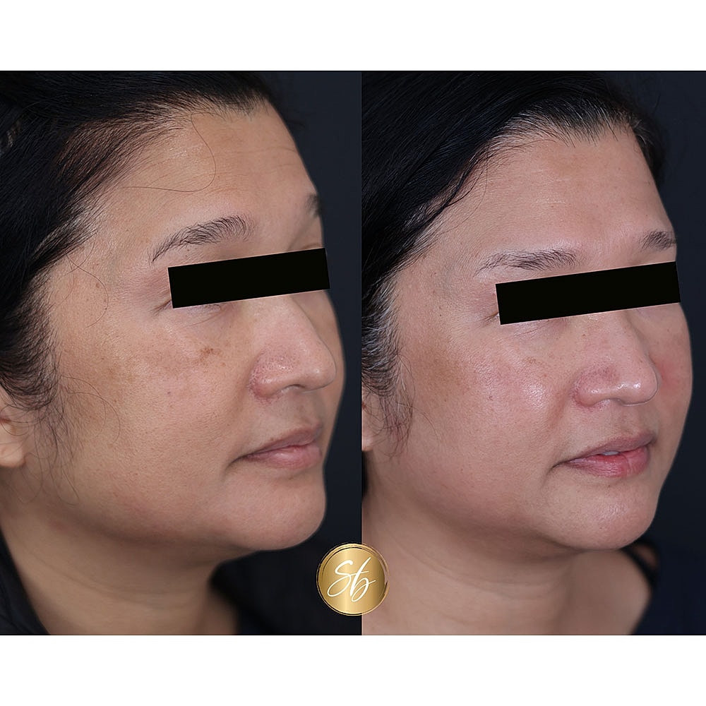 Before and after skincare treatment comparison image.