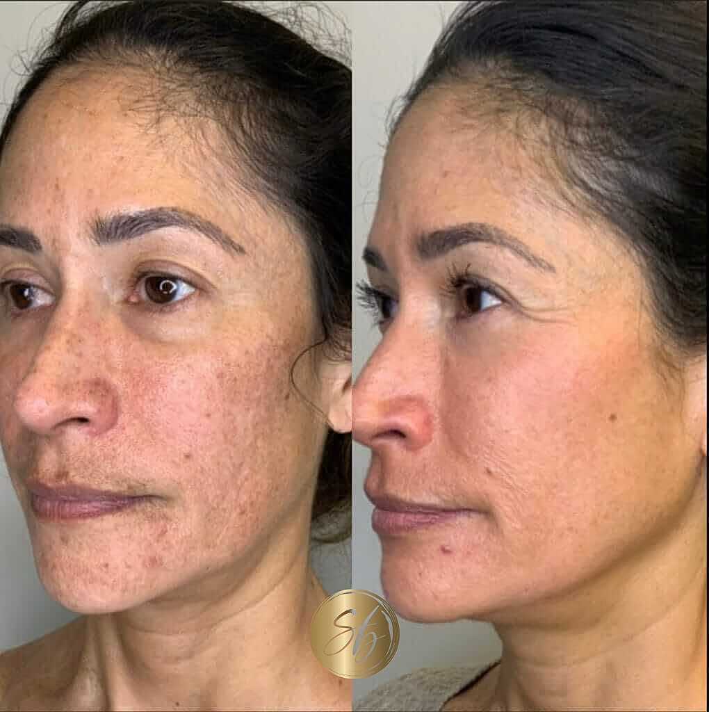 Cosmelan Peel Before & After