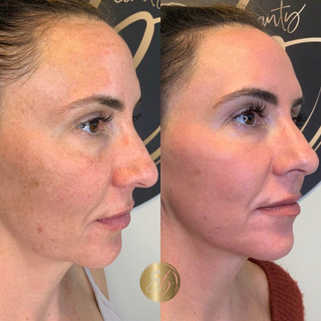 Cosmelan Peel Before & After