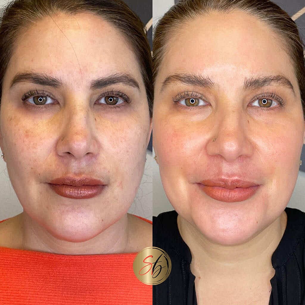 Cosmelan Peel Before & After