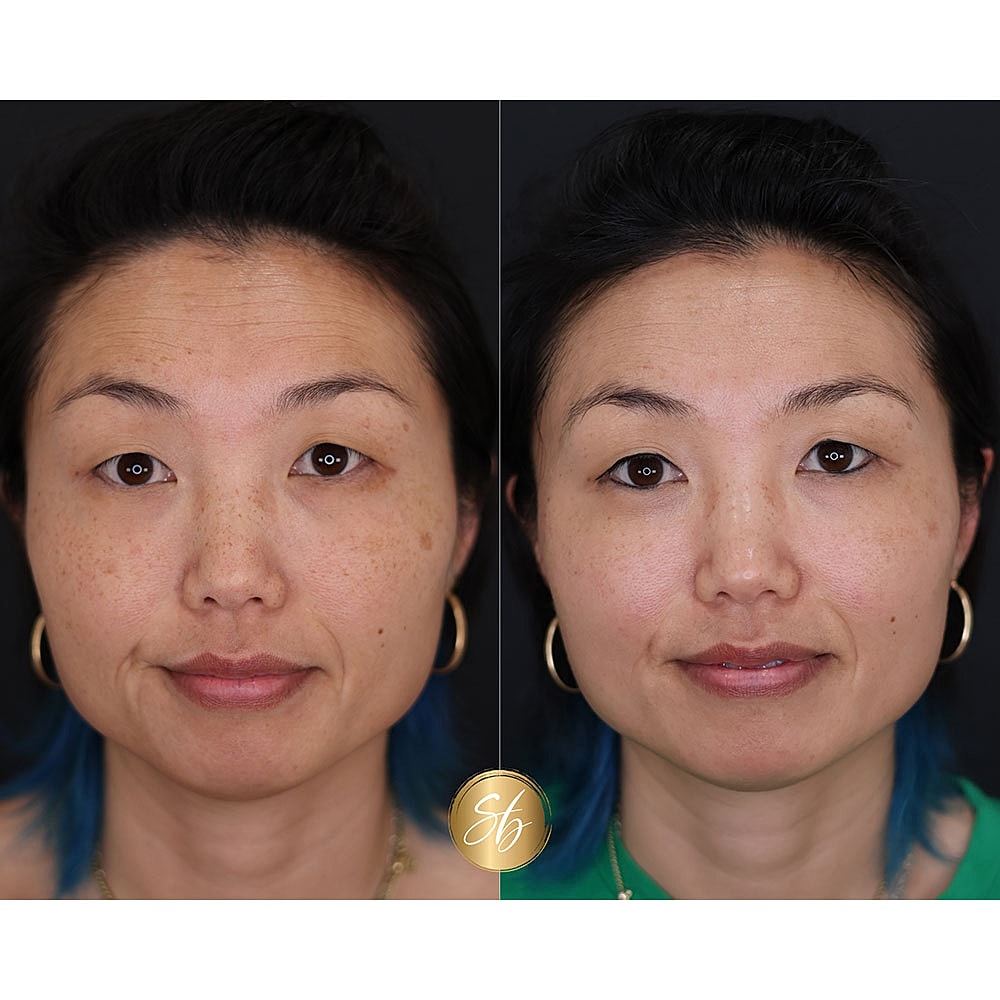 Before and after skin treatment comparison.