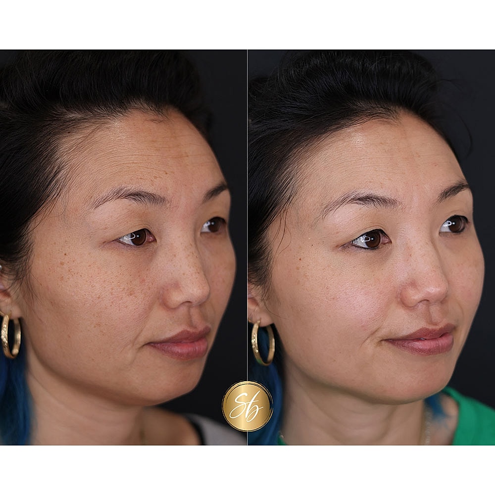 Before and after skincare treatment comparison.