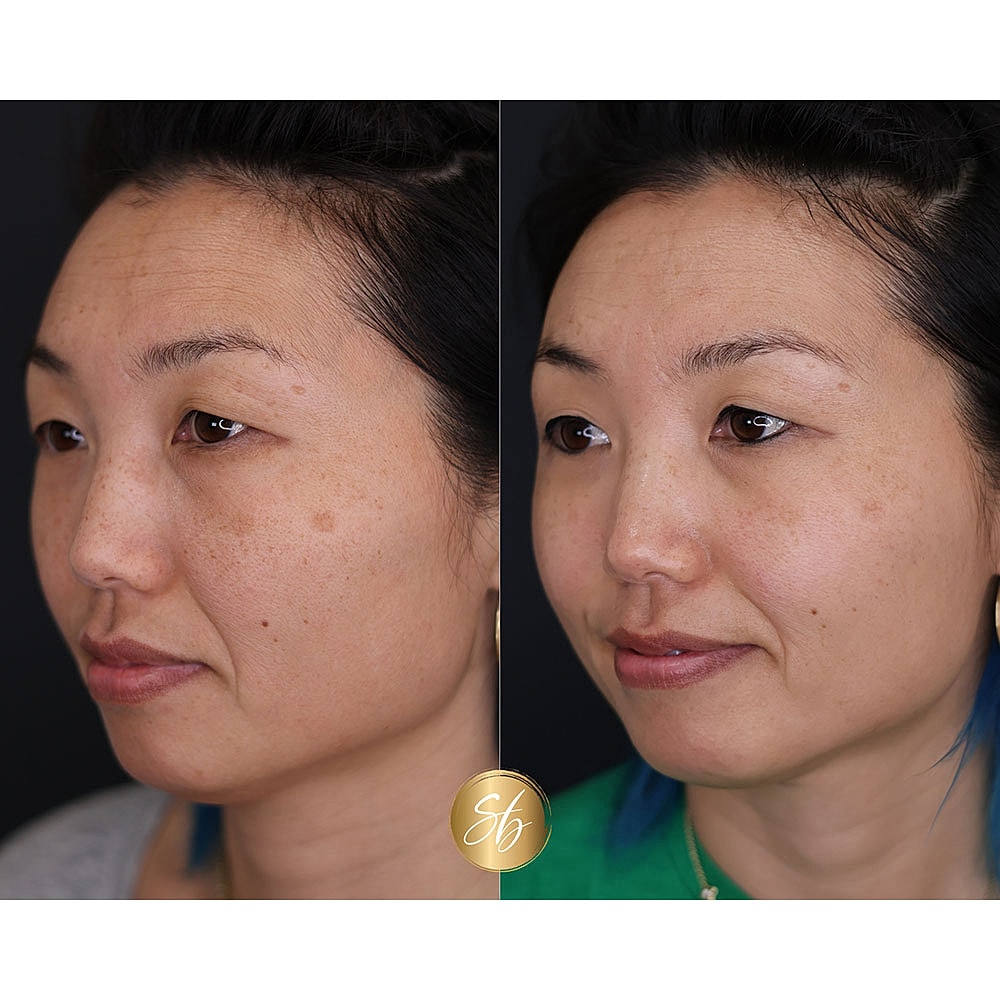 Before and after skincare treatment comparison.