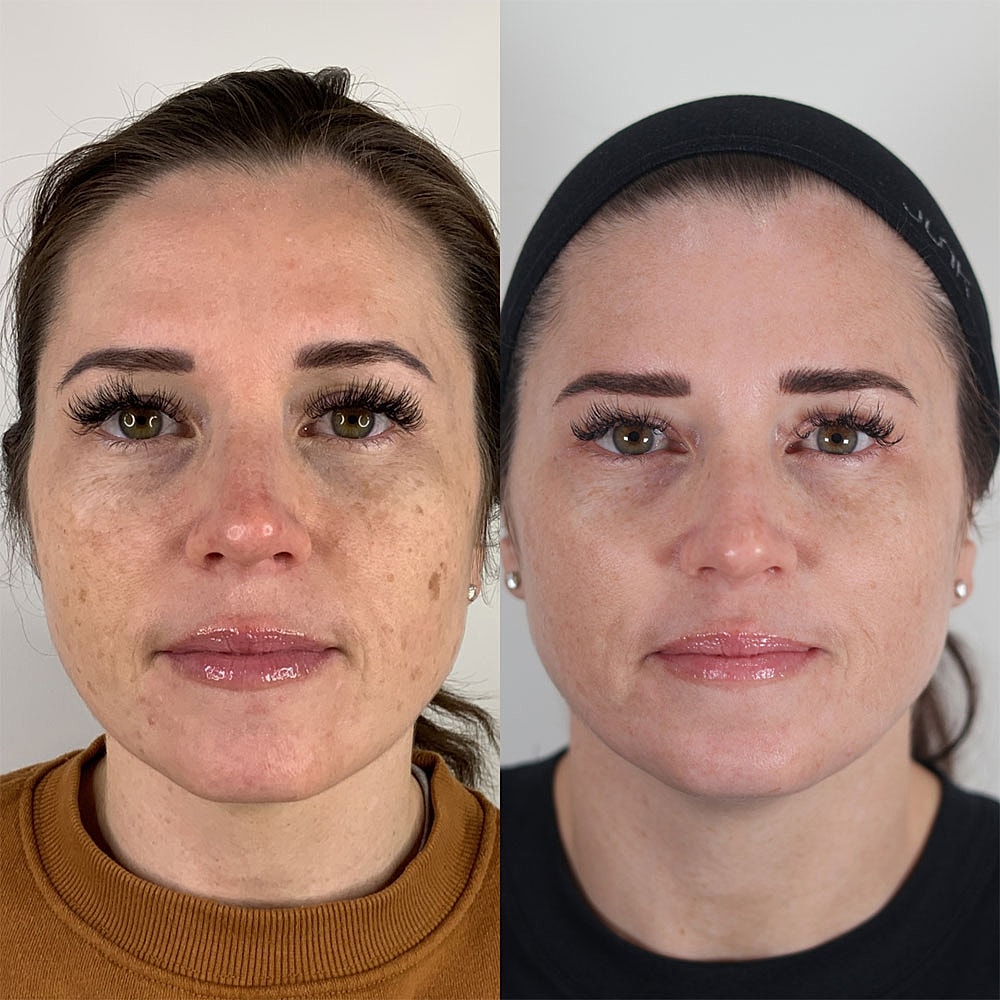 Before and after skincare treatment comparison.