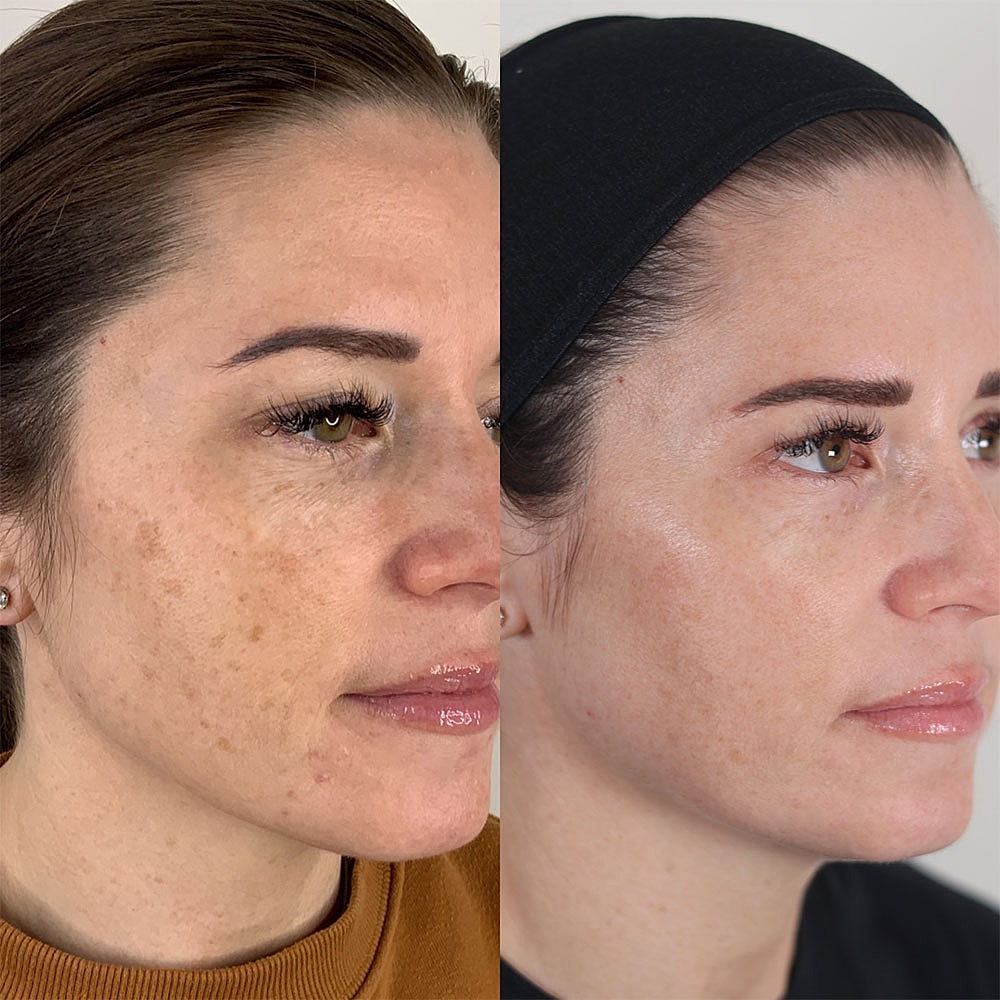 Before and after skincare treatment comparison.