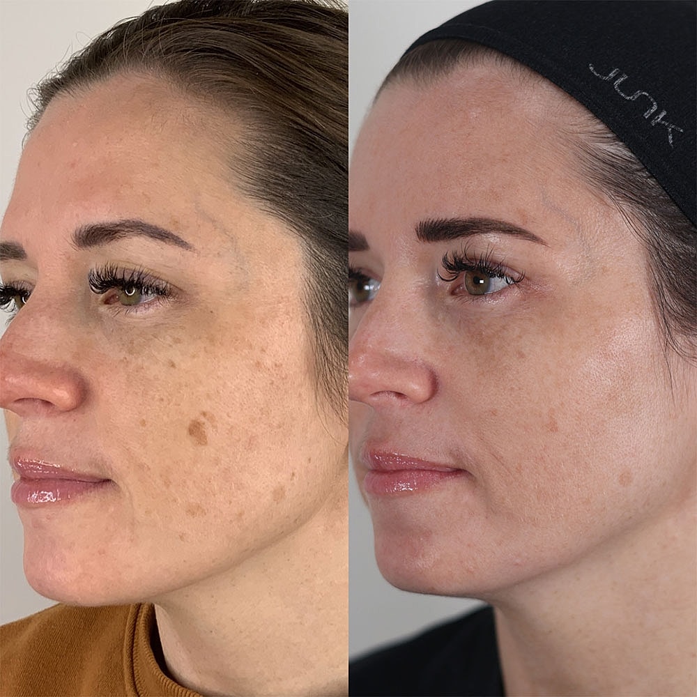 Before and after skin treatment comparison.
