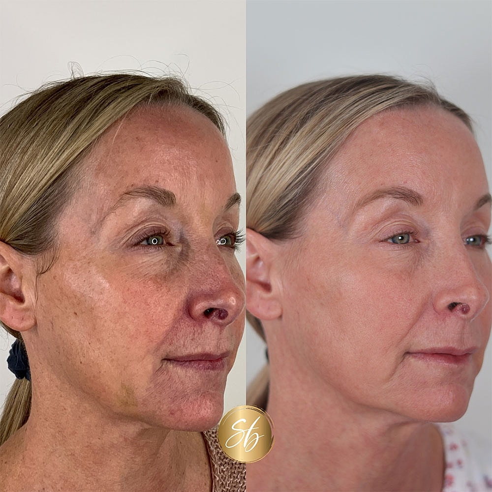 Before and after skincare results comparison photo.