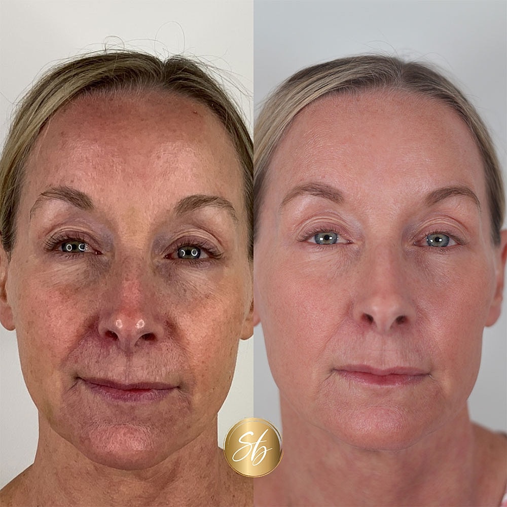 Before and after skincare treatment comparison image.
