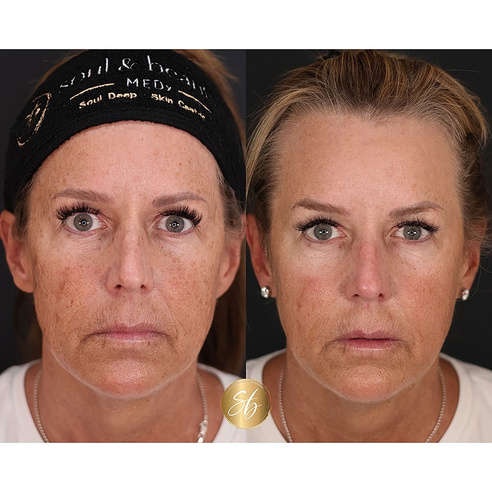 Before and after skincare treatment comparison photo.