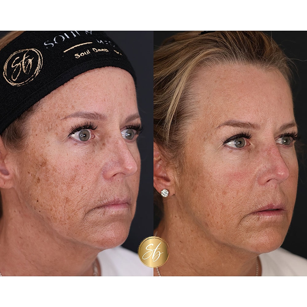 Before and after skin treatment comparison.