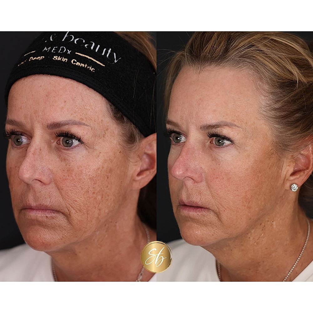 Before and after skin treatment comparison photo.