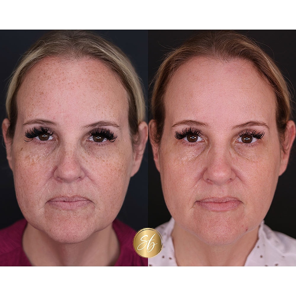 Before and after facial enhancement comparison.
