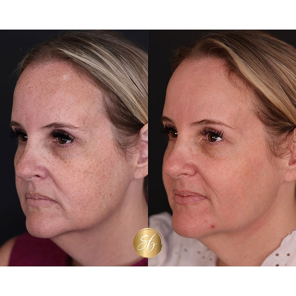 Before and after facial transformation comparison.