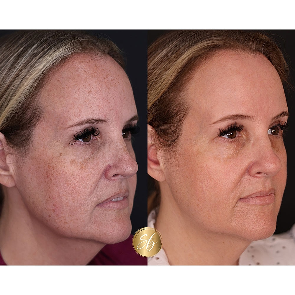 Before and after skin treatment comparison.