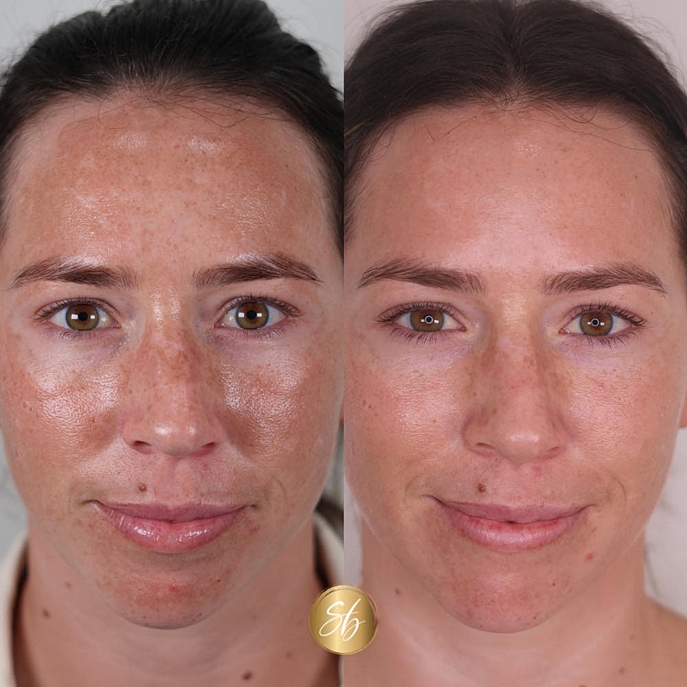 Before and after facial treatment comparison.