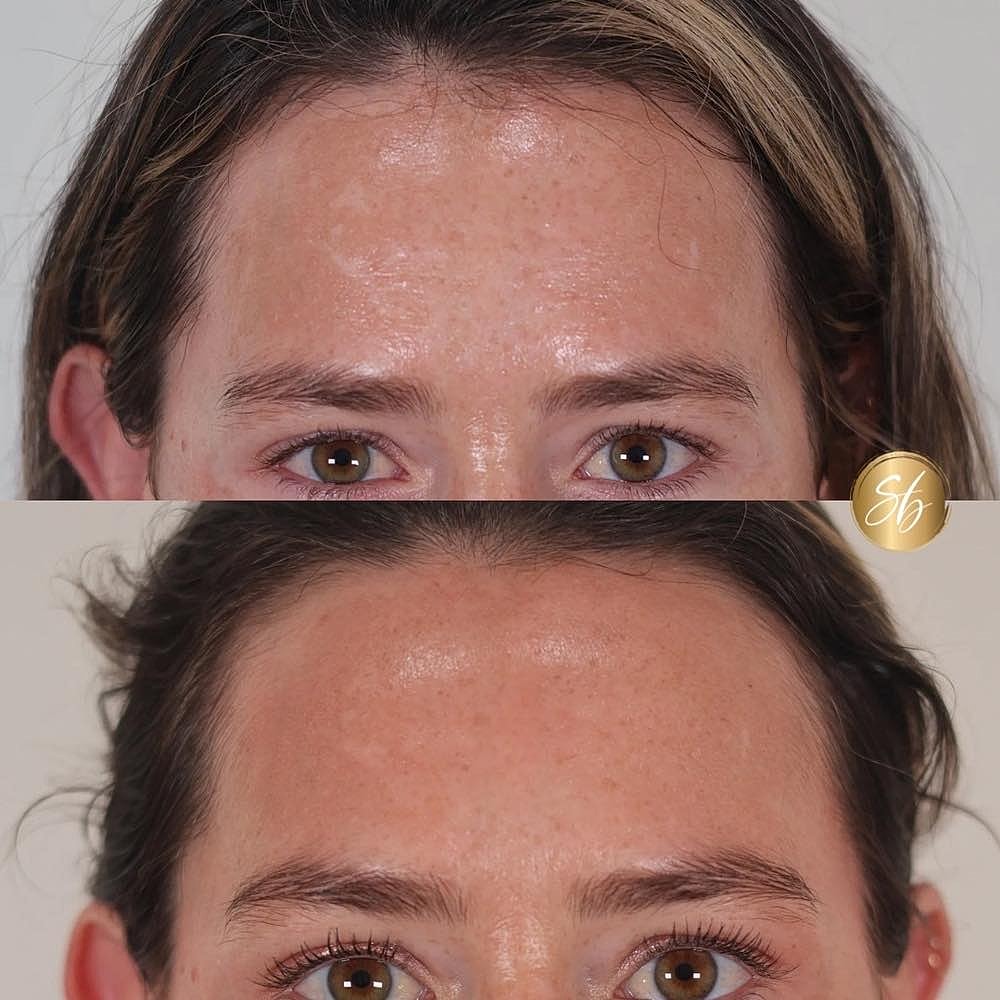 Comparison of skin texture before and after treatment