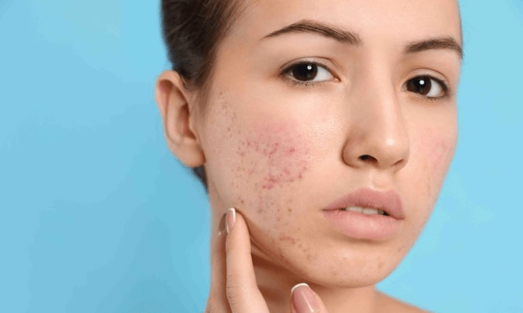 Ladera Ranch Acne Treatment | Soul and beauty MEDx