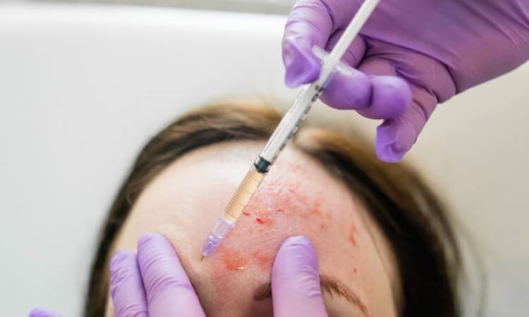 Microneedling with PRP in Mission Viejo, CA | Soul and Beauty MEDx