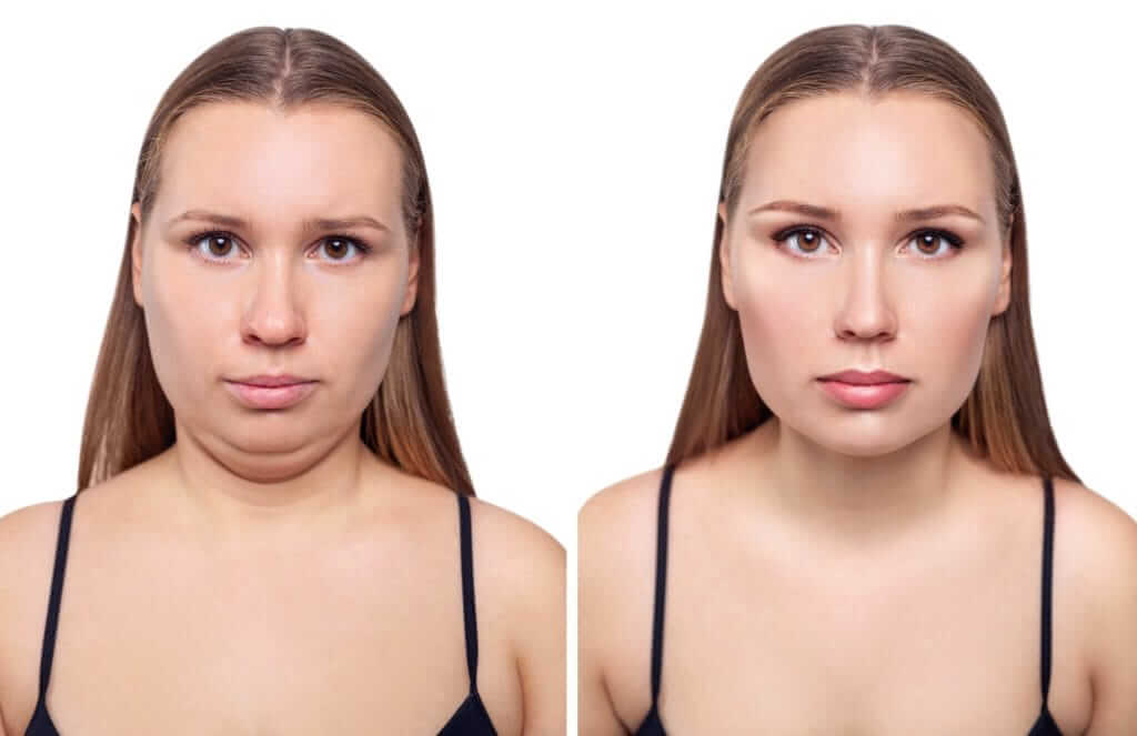 Before and After face of women | Soul And Beauty Med X | Mission Viejo CA
