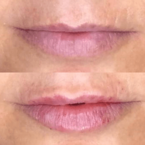 Lip fillers | Soul and Beauty MEDx | Mission Viejo, CA