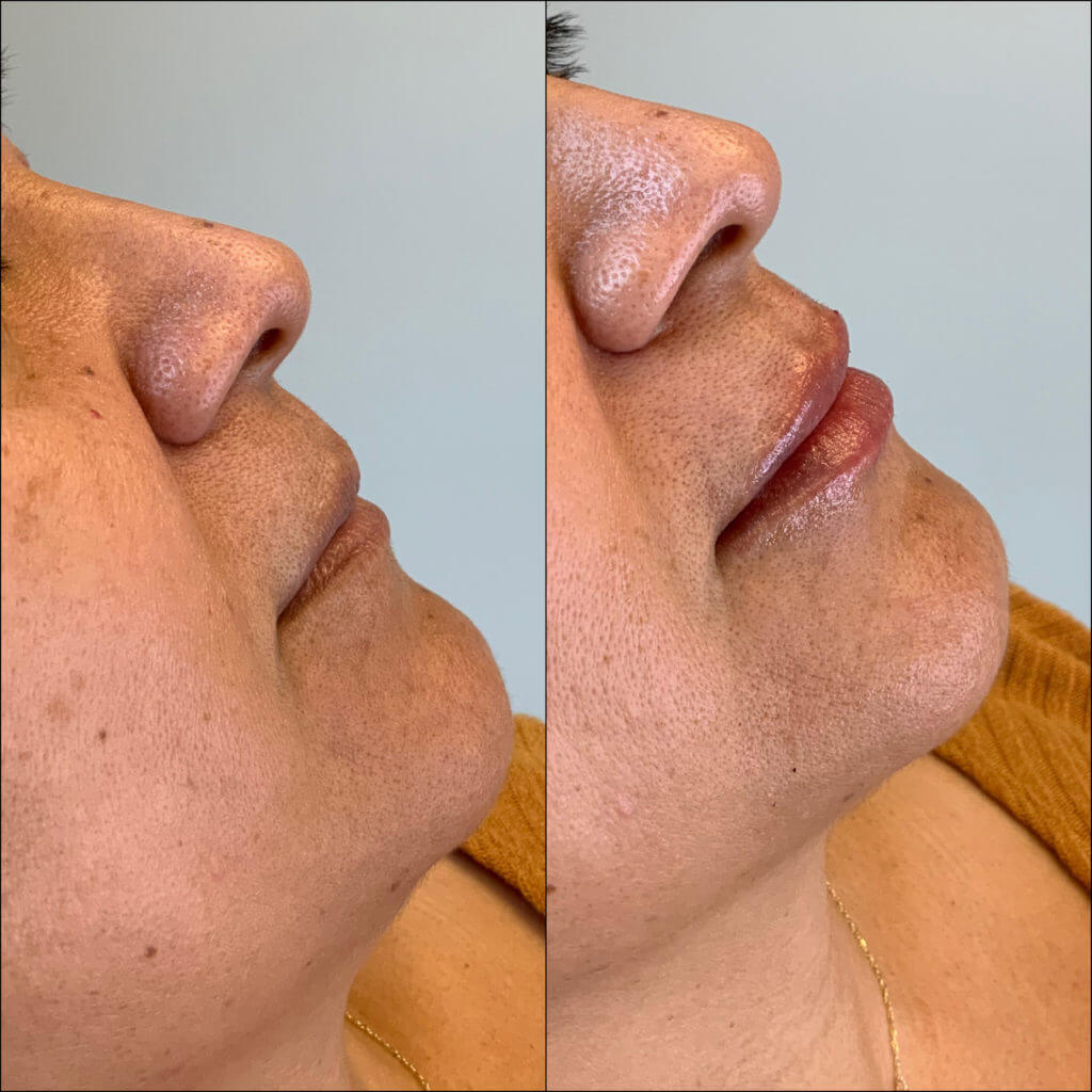Lips filler Before & after Treatment result in Mission Viejo, CA | Soul And Beauty Med X