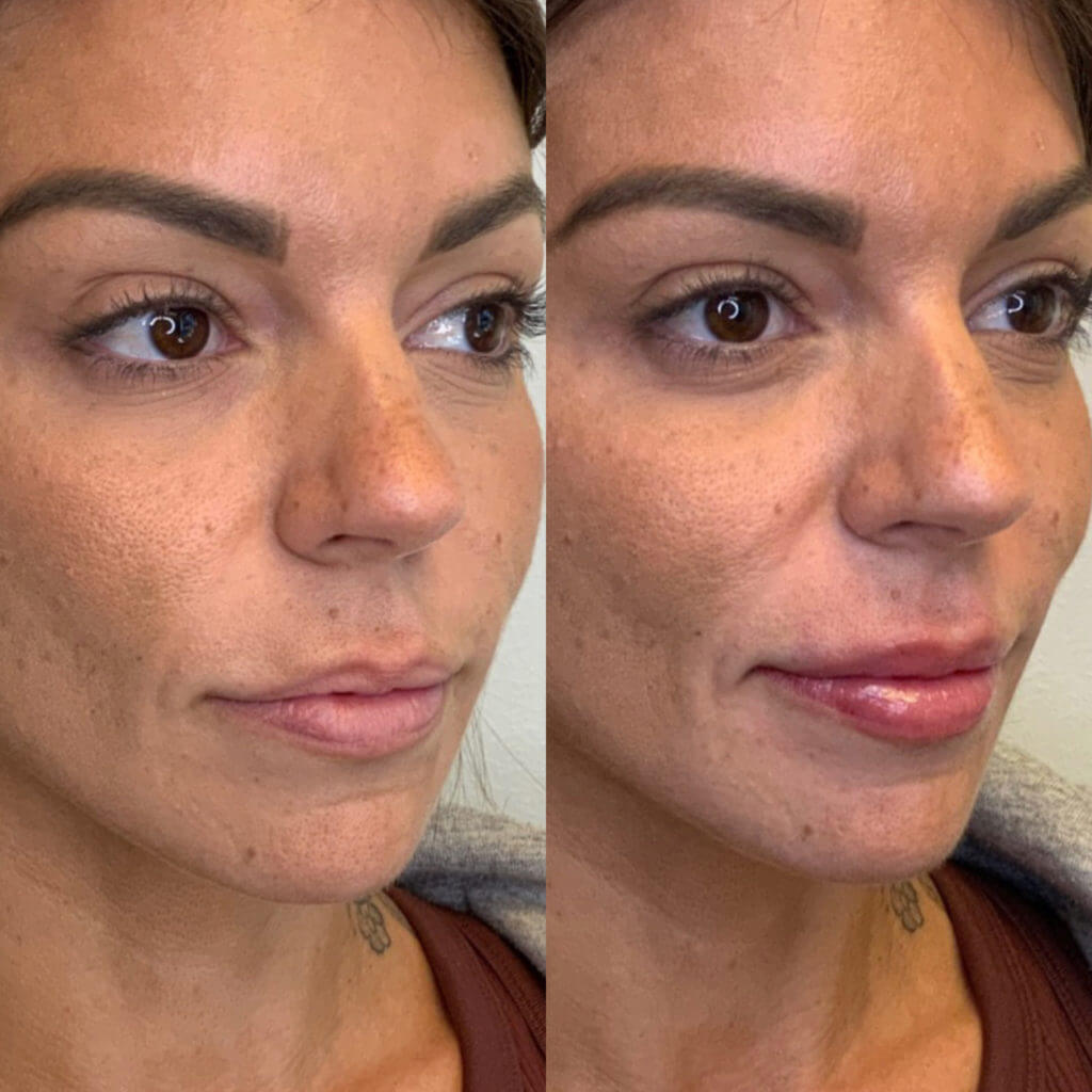 Lips Filler Services in MiViejo, CA | Soul And Beauty Med X