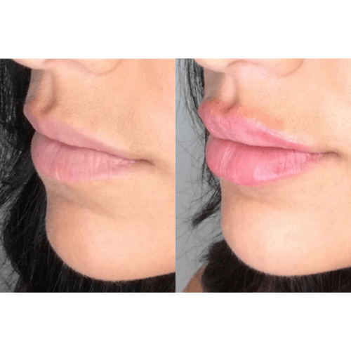 Lips filler Before and after Treatment result in Mission Viejo, CA | Soul And Beauty Med X