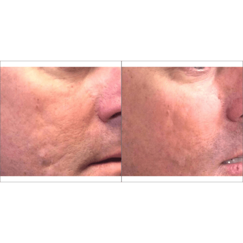 Skin treatment Before and after Treatment result in Mission Viejo, CA | Soul And Beauty Med X