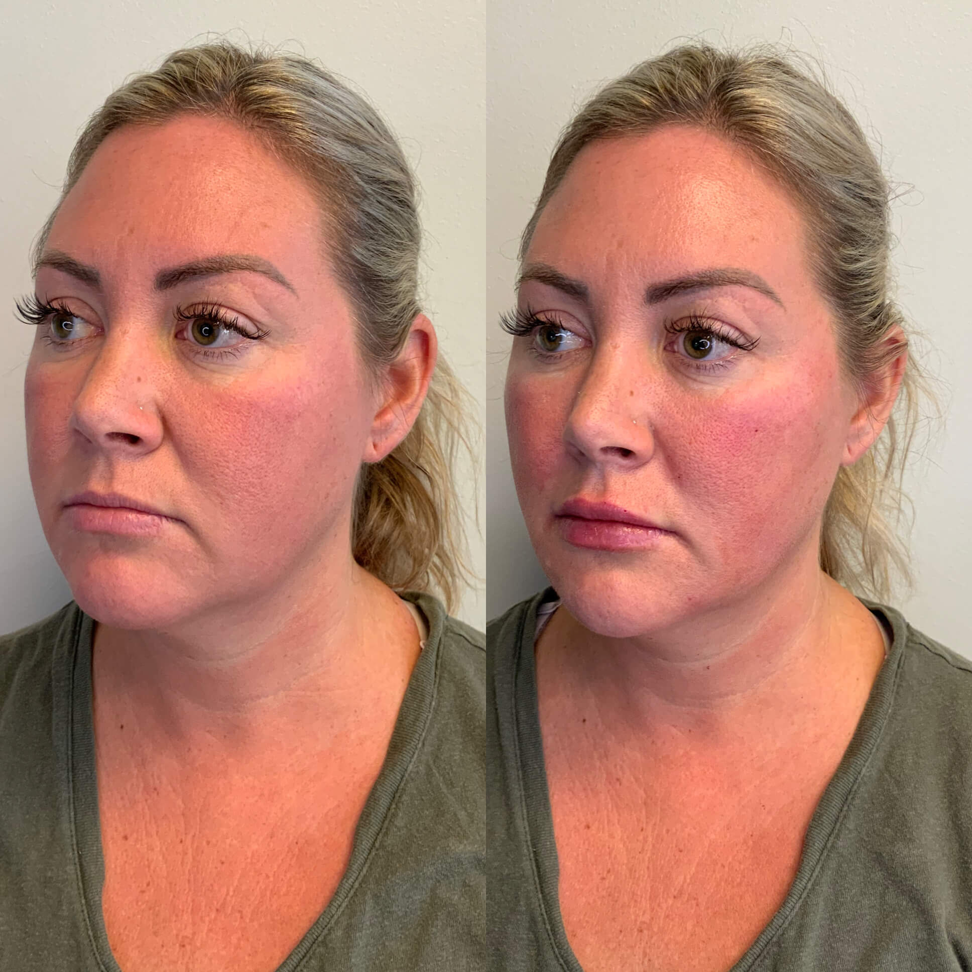 Facial Fillers Before And After Images Soul And Beauty Medx