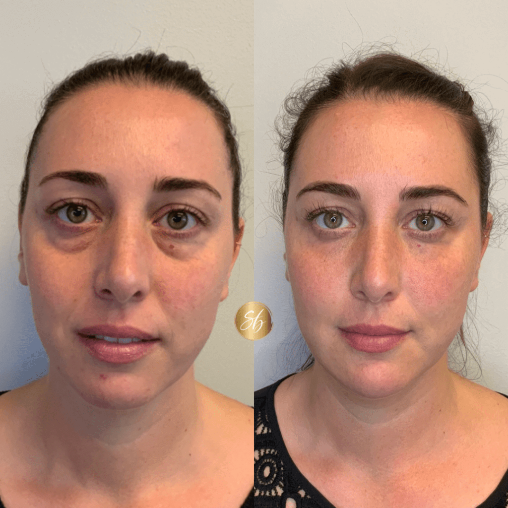 Facial Fillers Before & after Treatment result in Mission Viejo, CA | Soul And Beauty Med X