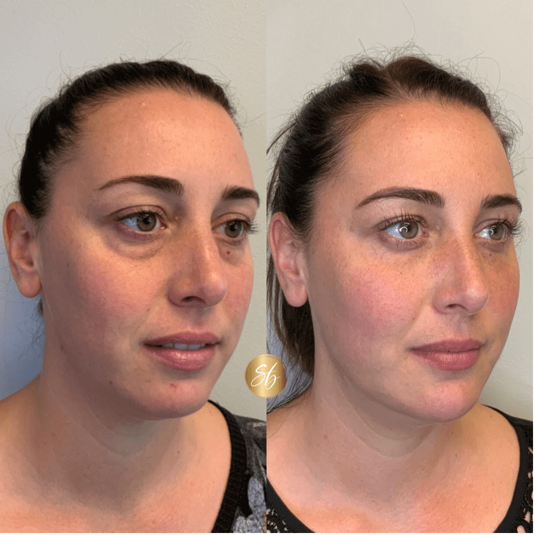 Lips filler Before & after Treatment result in Mission Viejo, CA | Soul And Beauty Med X