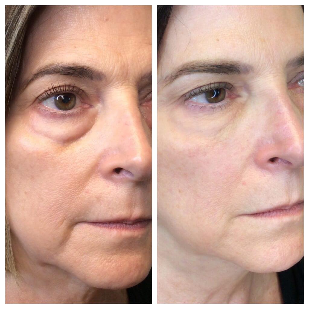 upper face before and after | Soul and Beauty MEDx | Mission Viejo, CA