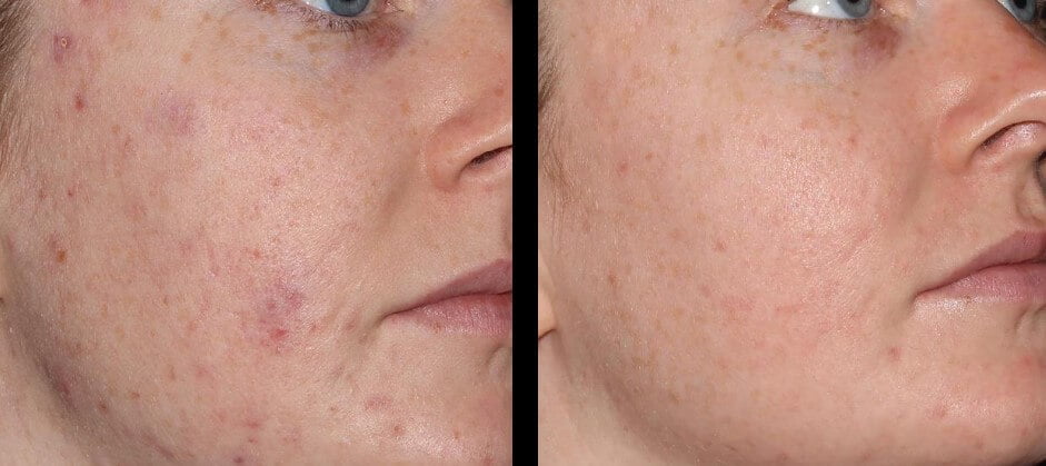 Before and after image of a women | soul and beauty medx. | Mission Viejo, CA