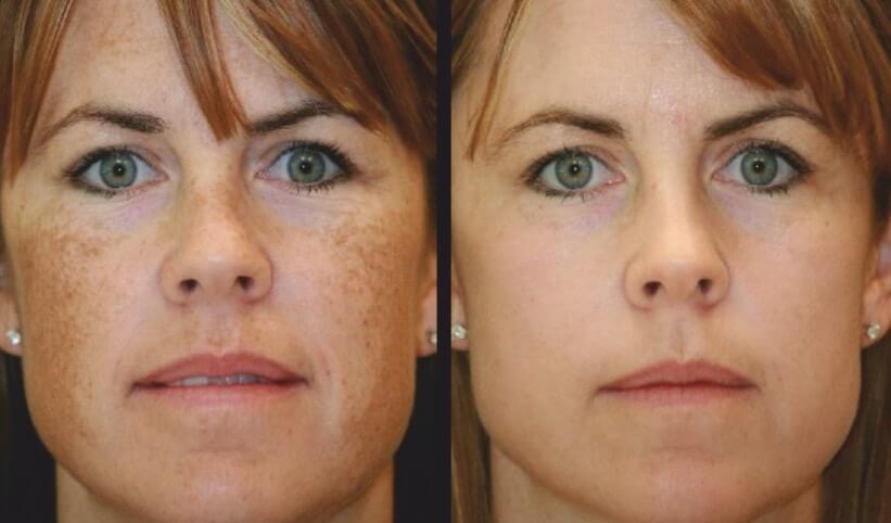 Before and after image | soul and beauty medx. | Mission Viejo, CA