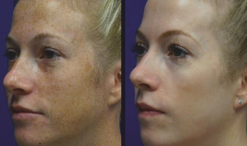 Before and after image | soul and beauty medx. | Mission Viejo, CA