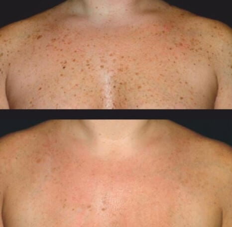 Before and after image of a men | soul and beauty medx. | Mission Viejo, CA