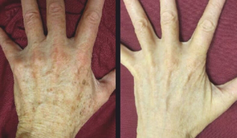 Before and after image of a hand of a women | soul and beauty medx. | Mission Viejo, CA