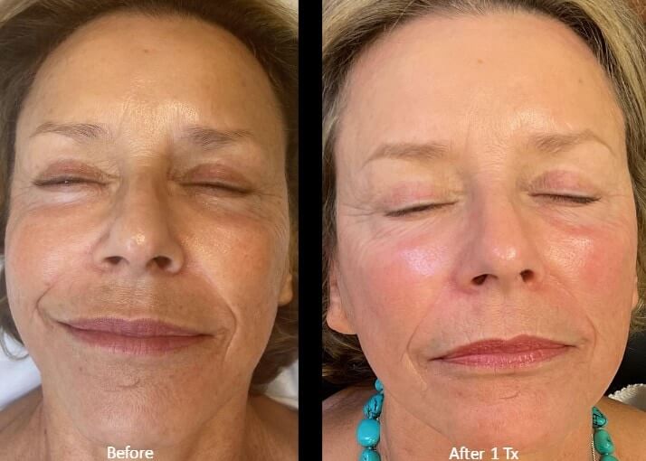 Before and after image of a women | soul and beauty medx. | Mission Viejo, CA
