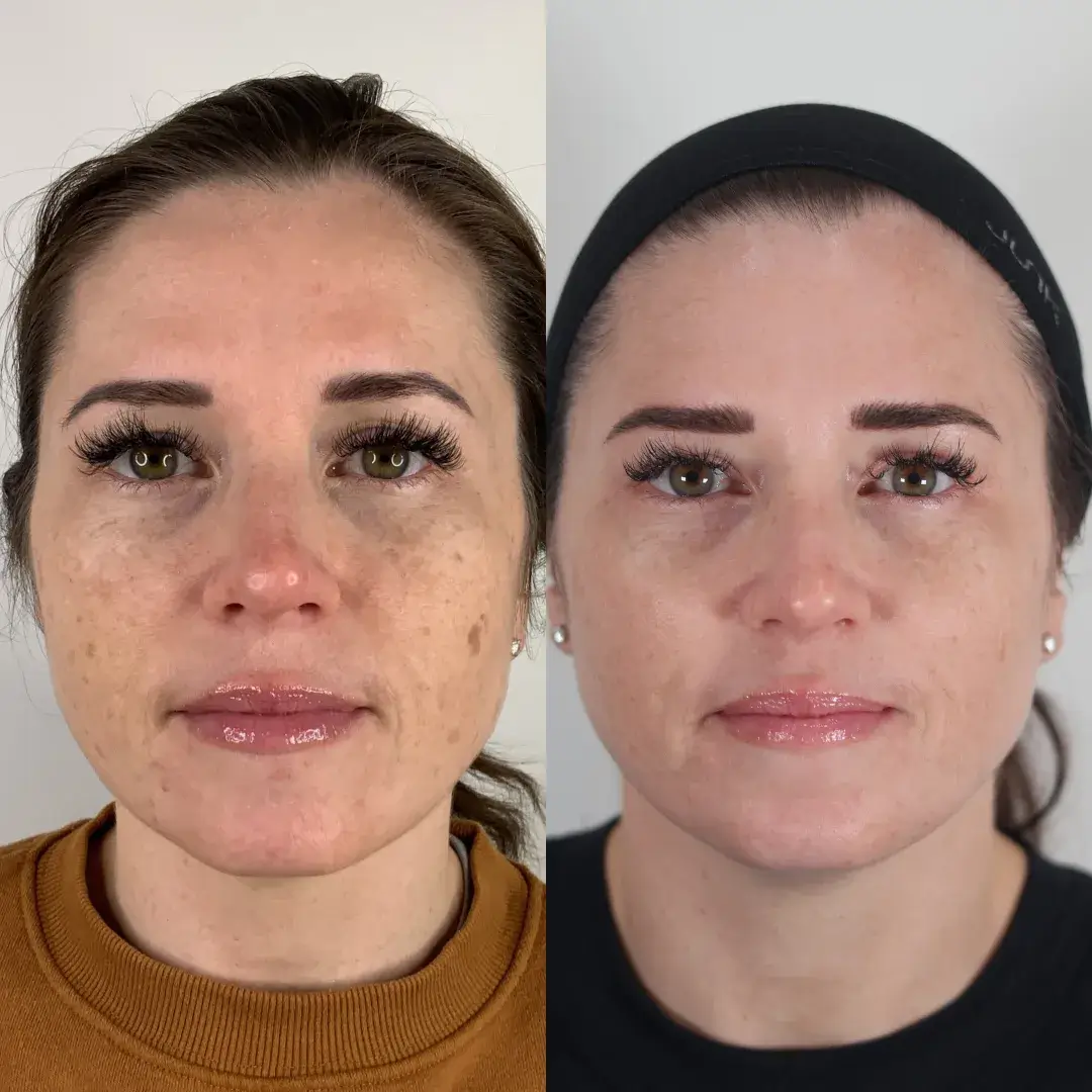 BBL | dark spots | before and after photo | Soul And Beauty Med X | Mission Viejo, CA