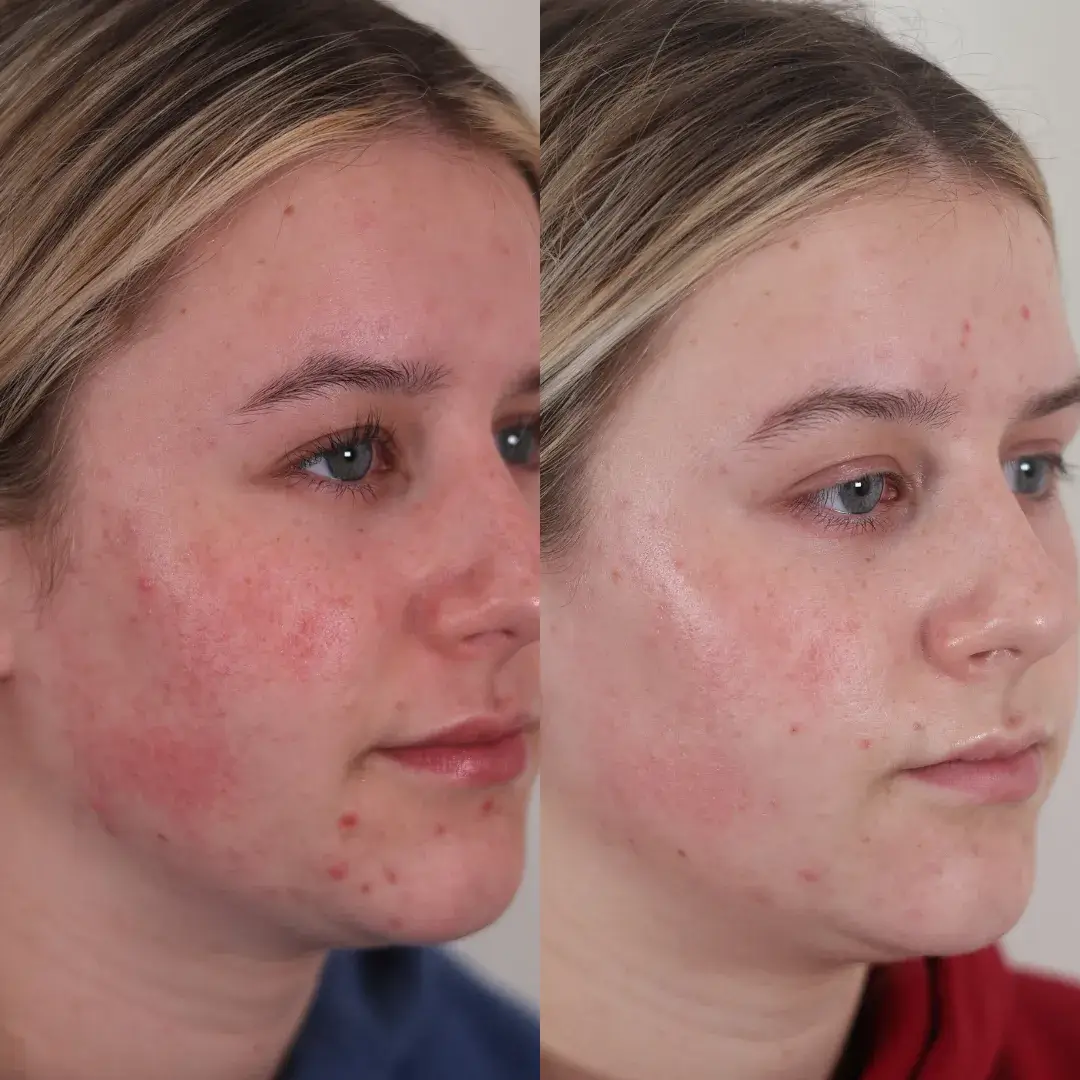 BBL Forever Clear | before and after | Soul And Beauty Med X | Mission Viejo, CA