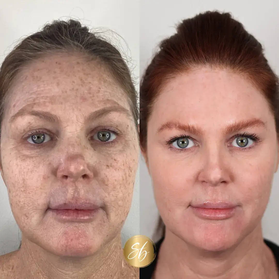 BBL + Moxi | before and after | Soul And Beauty Med X | Mission Viejo, CA