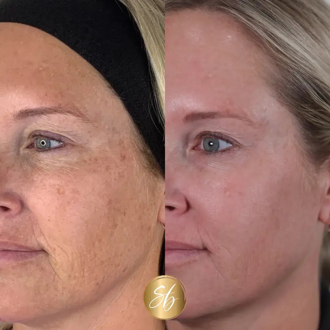 sun spots | before and after photo | Soul And Beauty Med X | Mission Viejo, CA